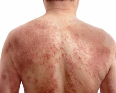 atopic dermatitis in adults)